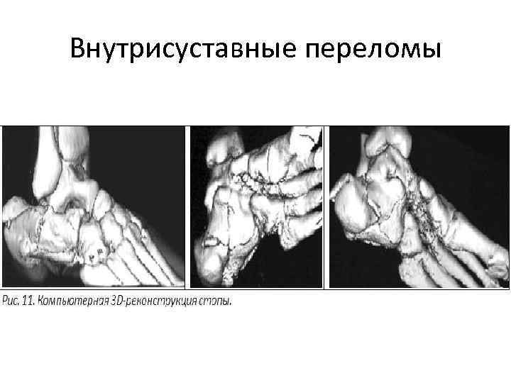 Внутрисуставные переломы 