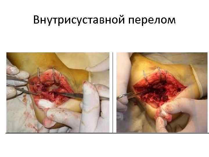 Внутрисуставной перелом 