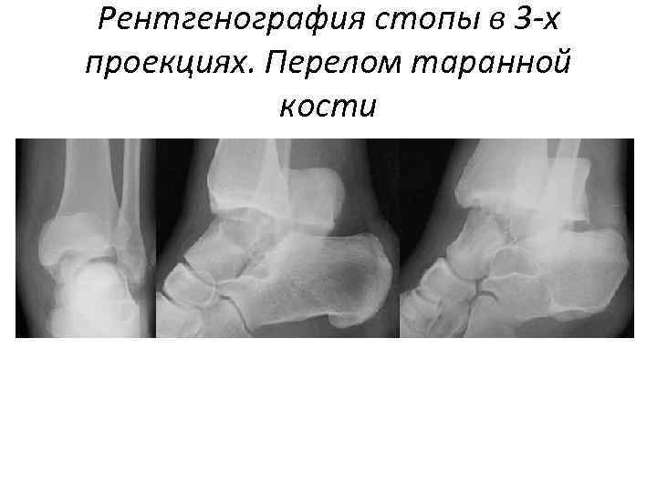 Рентгенография стопы в 3 -х проекциях. Перелом таранной кости 