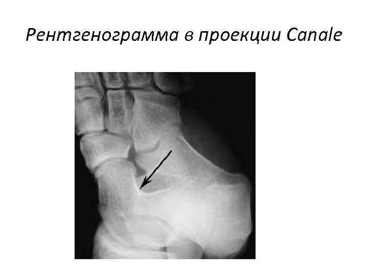 Рентгенограмма в проекции Canale 