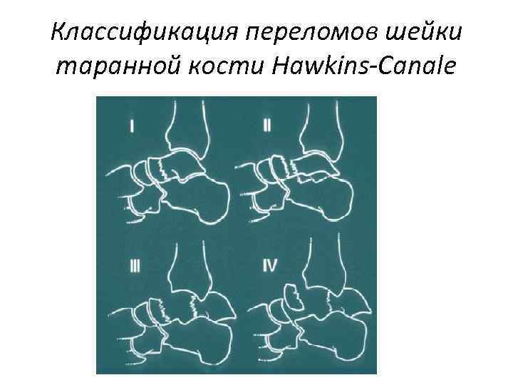Классификация переломов шейки таранной кости Hawkins-Canale 