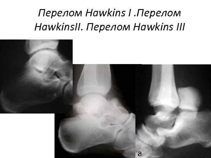 Перелом Hawkins I. Перелом Hawkins. II. Перелом Hawkins III 