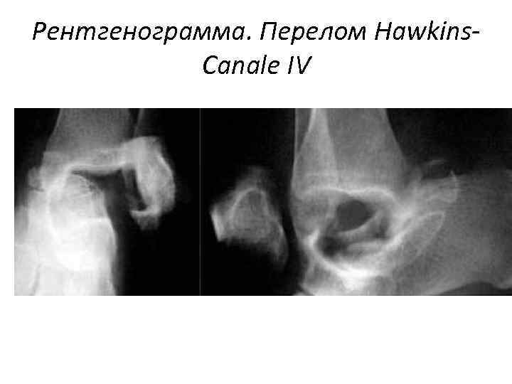 Рентгенограмма. Перелом Hawkins. Canale IV 
