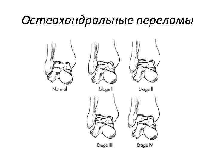 Остеохондральные переломы 