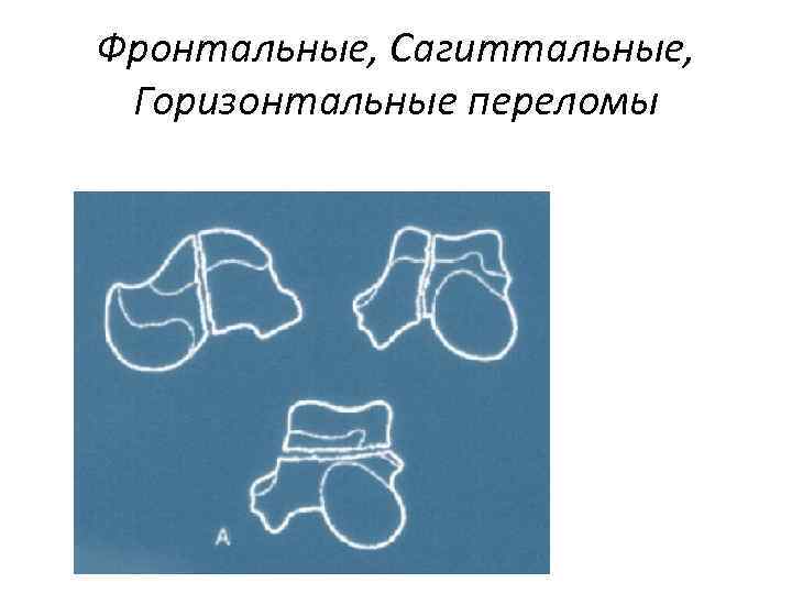 Фронтальные, Сагиттальные, Горизонтальные переломы 