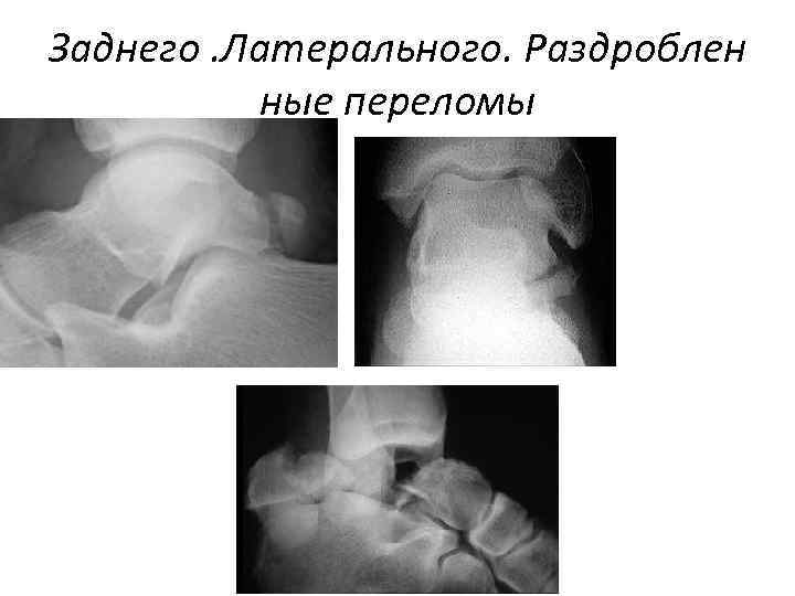 Заднего. Латерального. Раздроблен ные переломы 