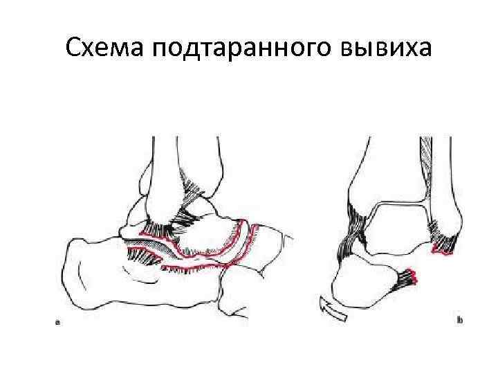 Схема подтаранного вывиха 