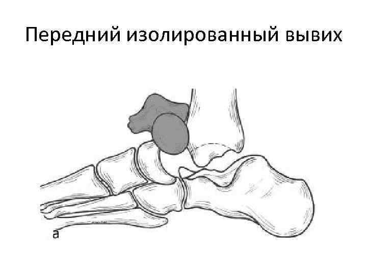 Передний изолированный вывих 