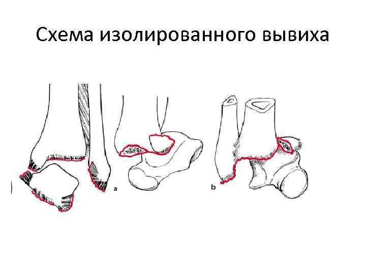 Схема изолированного вывиха 