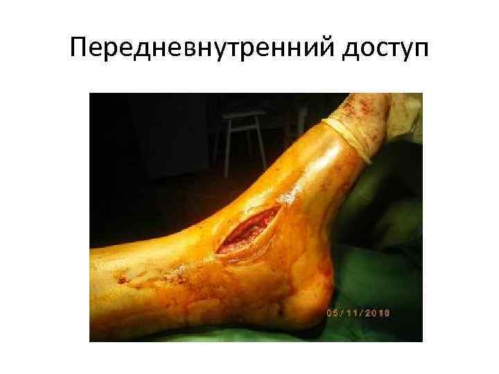 Передневнутренний доступ 