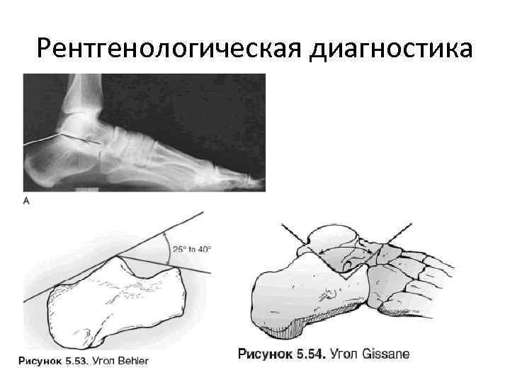 Перелом пяточной кости карта вызова