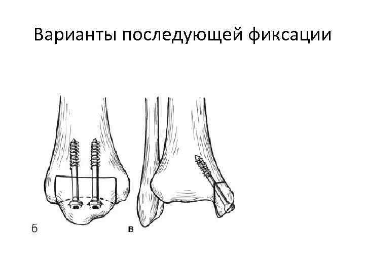 Варианты последующей фиксации 