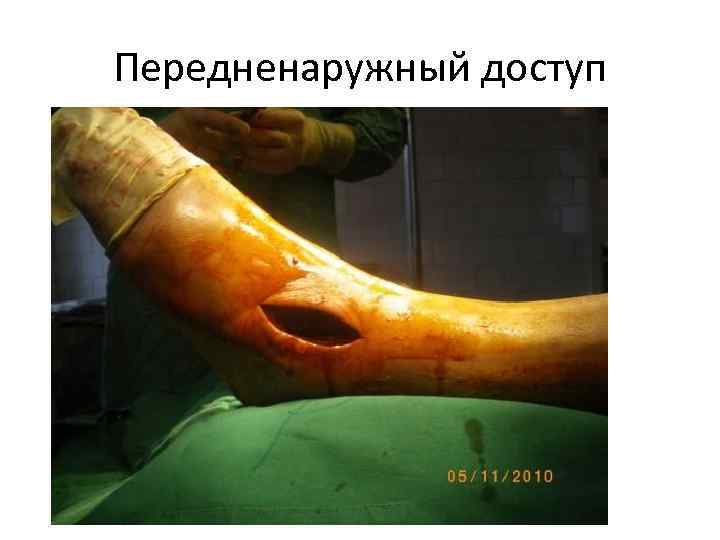 Передненаружный доступ 