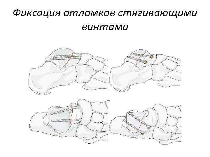 Фиксация отломков стягивающими винтами 