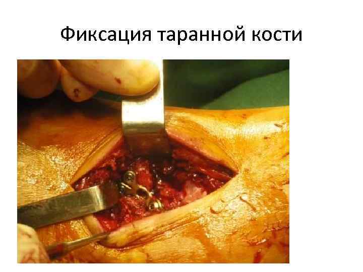 Фиксация таранной кости 