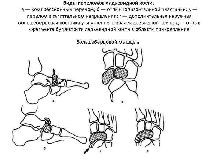 Виды переломов ладьевидной кости. а — компрессионный перелом; б — отрыв горизонтальной пластинки; в