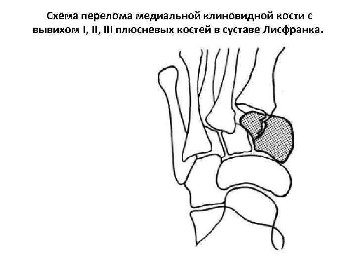 Схема перелома медиальной клиновидной кости с вывихом I, III плюсневых костей в суставе Лисфранка.