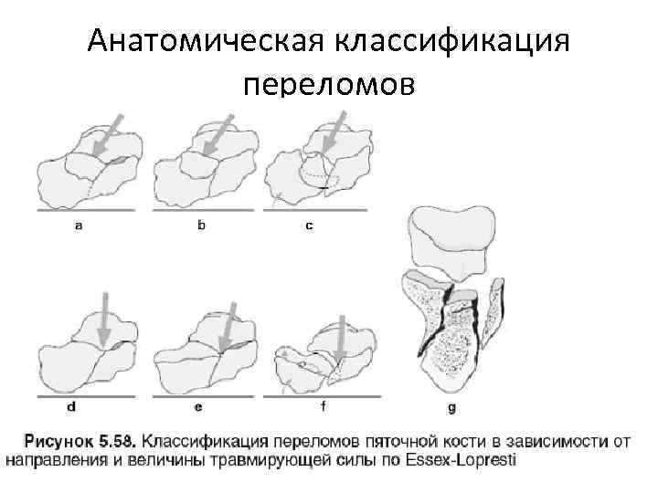 Анатомическая классификация переломов 
