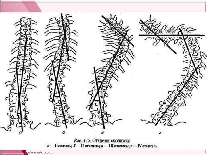 Стадии искривления