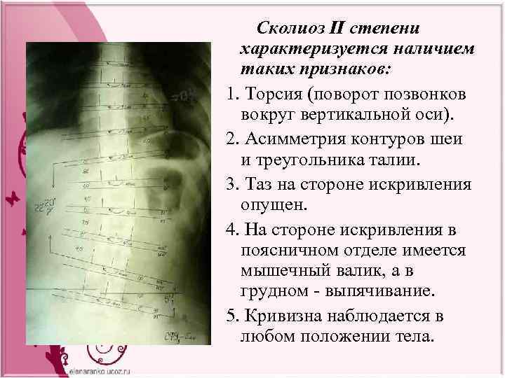 Сколиоз какие степени. Торсия позвонков 2 степени. Торсионная деформация позвонко. Торсия тел позвонков 1 степени. Сколиоз характеризуется.