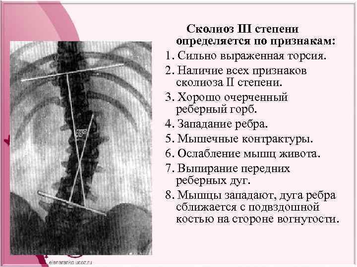 Сколиоз III степени определяется по признакам: 1. Сильно выраженная торсия. 2. Наличие всех признаков