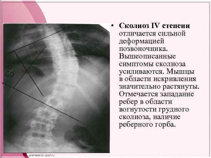  • Сколиоз IV степени отличается сильной деформацией позвоночника. Вышеописанные симптомы сколиоза усиливаются. Мышцы