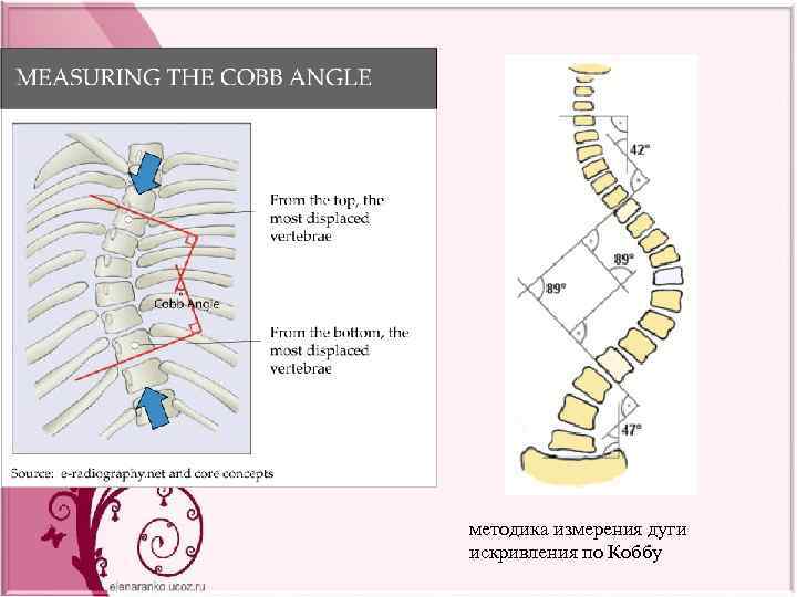 Угол кобба. Методика измерения дуги искривления по коббу. Измерение сколиоза по коббу. Угол сколиоза по коббу. Сколиотическая дуга метод Кобба.