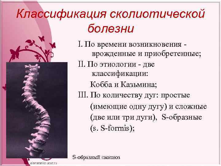 Классификация сколиотической болезни I. По времени возникновения - врожденные и приобретенные; II. По этиологии