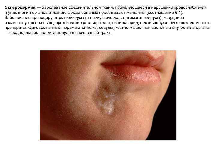 Склеродермия — заболевание соединительной ткани, проявляющееся в нарушении кровоснабжения и уплотнении органов и тканей.