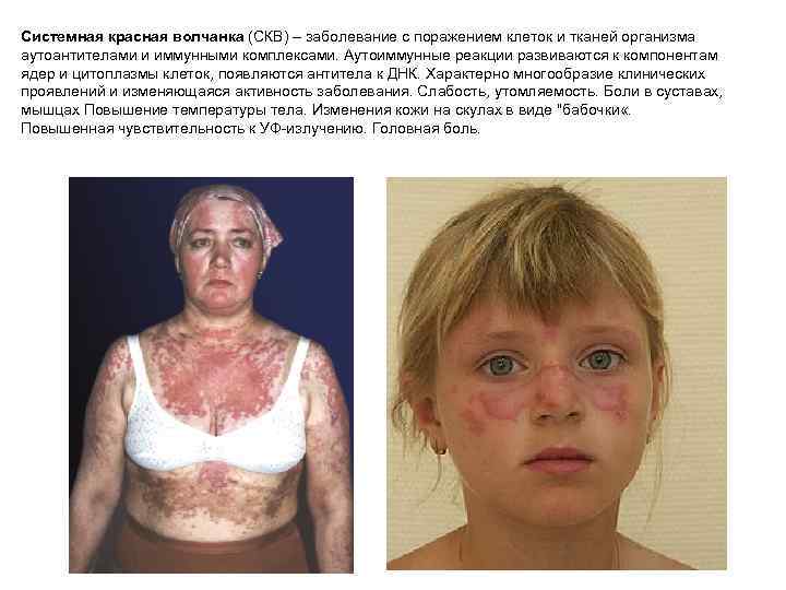 Системная красная волчанка (СКВ) – заболевание с поражением клеток и тканей организма аутоантителами и