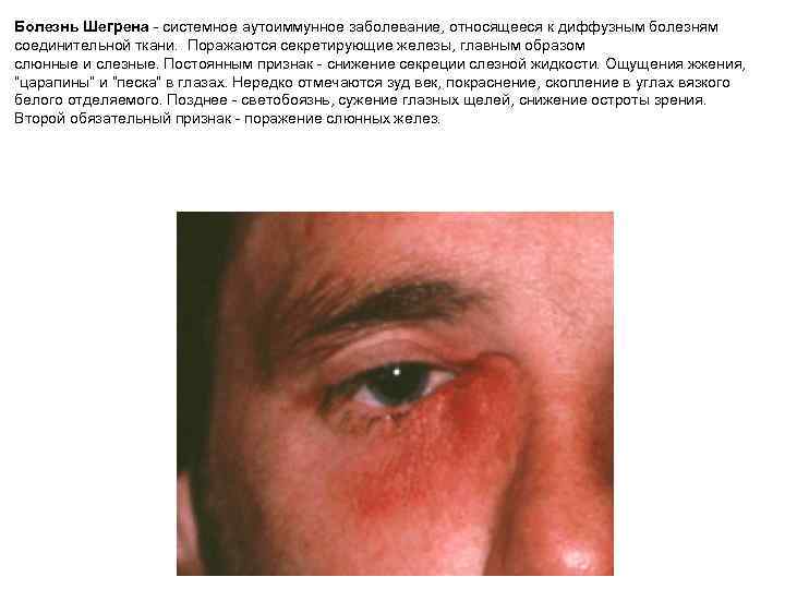 Болезнь Шегрена - системное аутоиммунное заболевание, относящееся к диффузным болезням соединительной ткани. Поражаются секретирующие