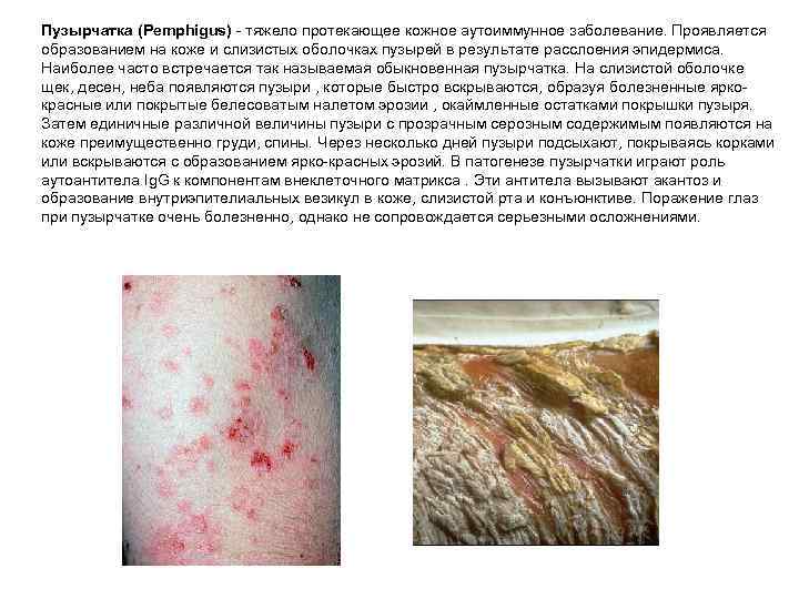 Пузырчатка (Pemphigus) - тяжело протекающее кожное аутоиммунное заболевание. Проявляется образованием на коже и слизистых