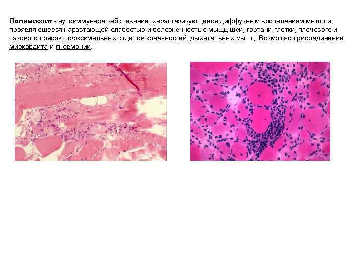 Полимиозит - аутоиммунное заболевание, характеризующееся диффузным воспалением мышц и проявляющееся нарастающей слабостью и болезненностью