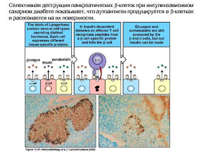 Селективная деструкция панкреатических b-клеток при инсулинзависимом сахарном диабете показывает, что аутоантиген продуцируется в b-клетках