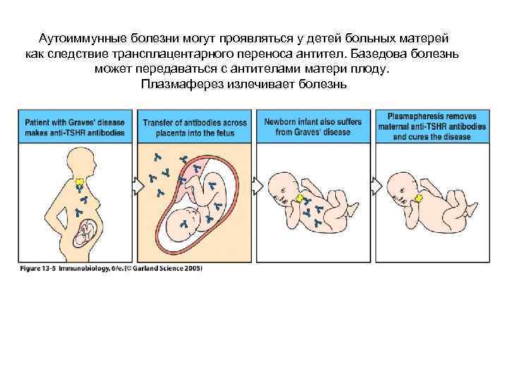 Аутоиммунные болезни могут проявляться у детей больных матерей как следствие трансплацентарного переноса антител. Базедова