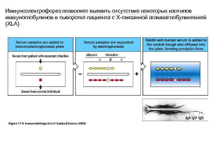 Иммуноэлектрофорез позволяет выявить отсутствие некоторых изотипов иммуноглобулинов в сыворотке пациента с X-связанной агаммаглобулинемией (XLA)