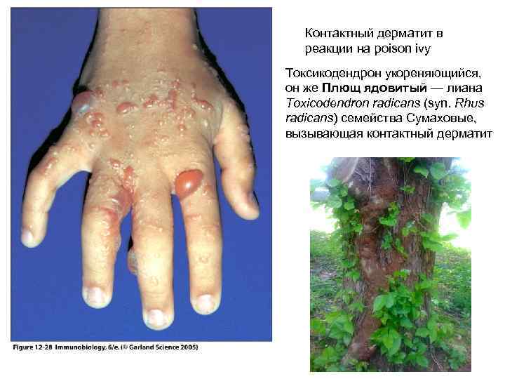 Контактный дерматит в реакции на poison ivy Токсикодендрон укореняющийся, он же Плющ ядовитый —