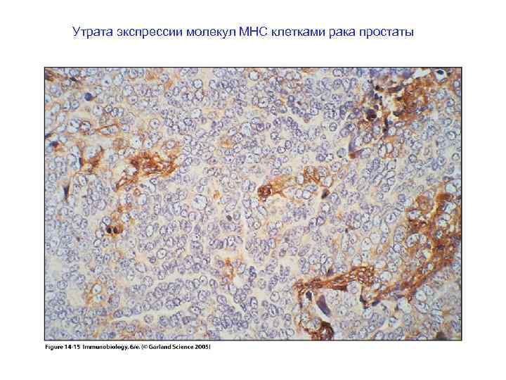 Утрата экспрессии молекул MHC клетками рака простаты 