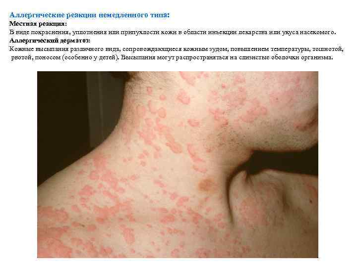 Аллергические реакции немедленного типа: Местная реакция: В виде покраснения, уплотнения или припухлости кожи в