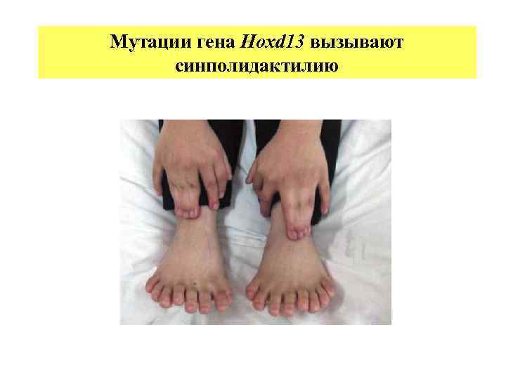 Мутации гена Нохd 13 вызывают синполидактилию 