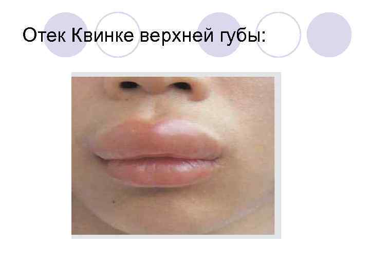 Отек Квинке верхней губы: 