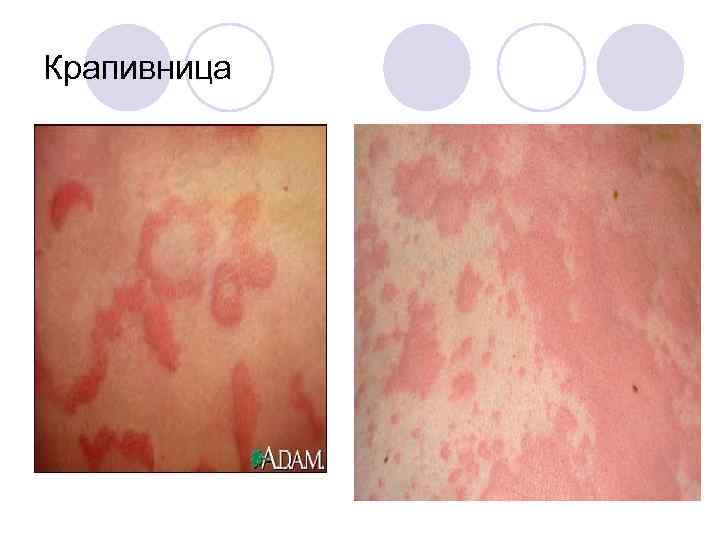 Крапивница 