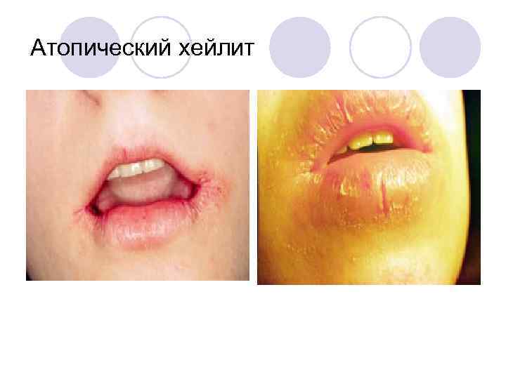 Атопический хейлит 