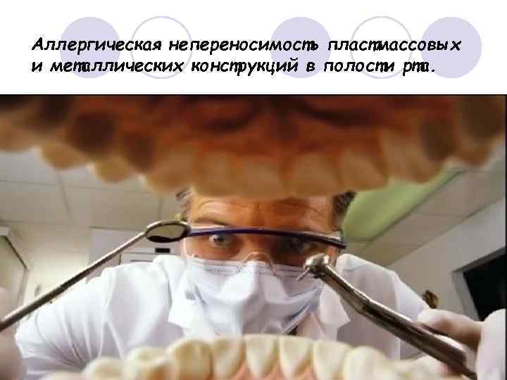 Аллергическая непереносимость пластмассовых и металлических конструкций в полости рта. 