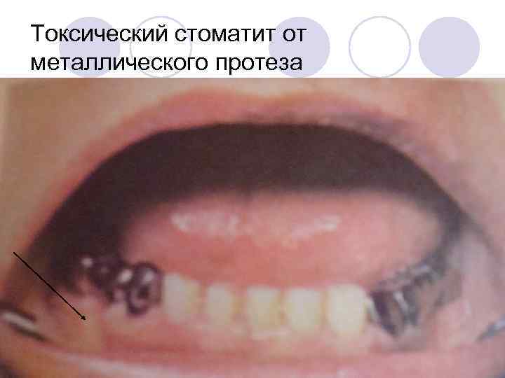 Токсический стоматит от металлического протеза 