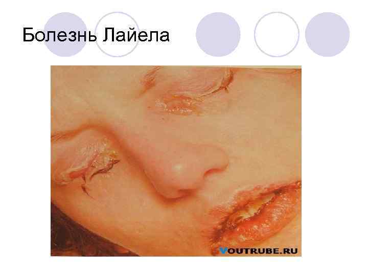 Болезнь Лайела 