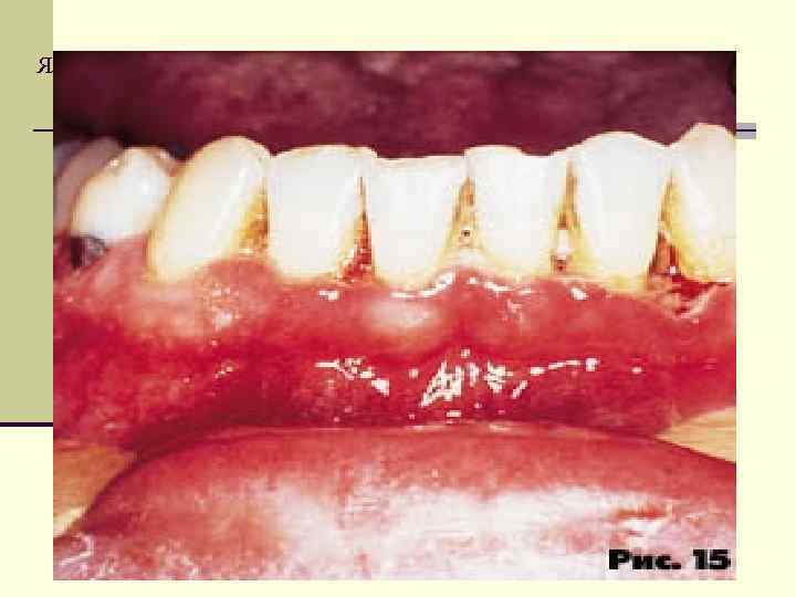 Язвенный гингивит 