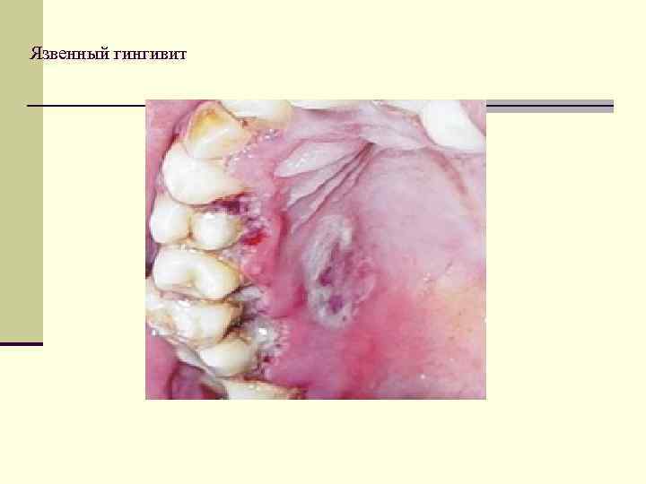 Язвенный гингивит 