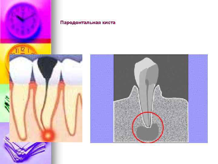 Пародонтальная киста 