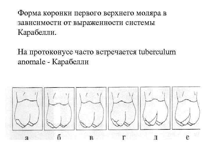 Форма коронки первого верхнего моляра в зависимости от выраженности системы Карабелли. На протоконусе часто